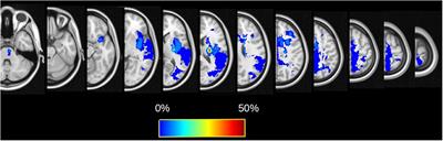Association between superior longitudinal fasciculus, motor recovery, and motor outcome after stroke: a cohort study